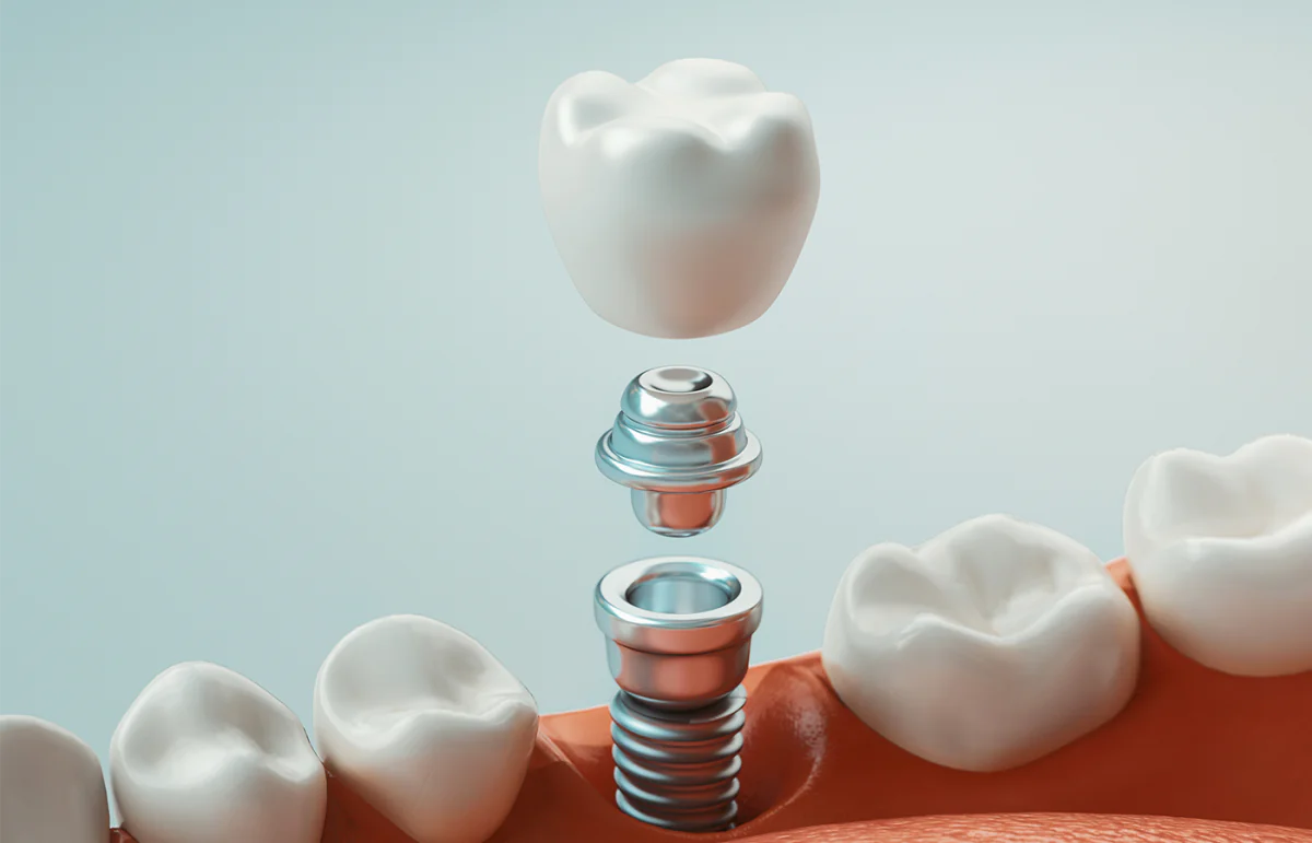 Dental Implants_1400x900.png